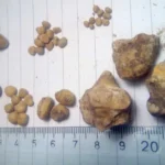 Kidney Stones in Hyderabad and Telangana: Why They’re So Common and How to Prevent Them