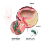 Urinary Tract Infection (UTI): Causes, Symptoms & What You Need to Know