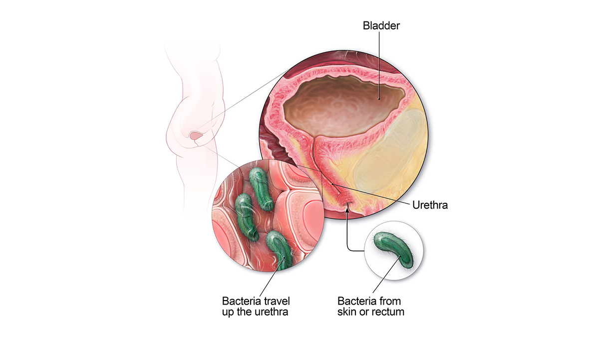Urinary Tract Infection (UTI): Causes, Symptoms & What You Need to Know