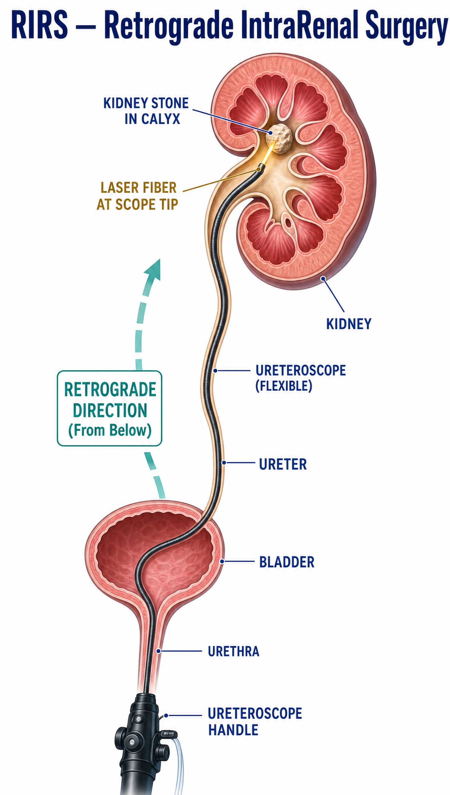 Infographic showing Retrograde Intrarenal Surgery (RIRS) for kidney stones